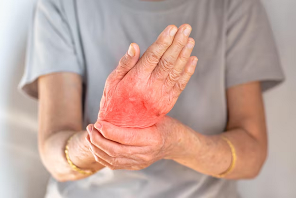 Rheumatic Disorders