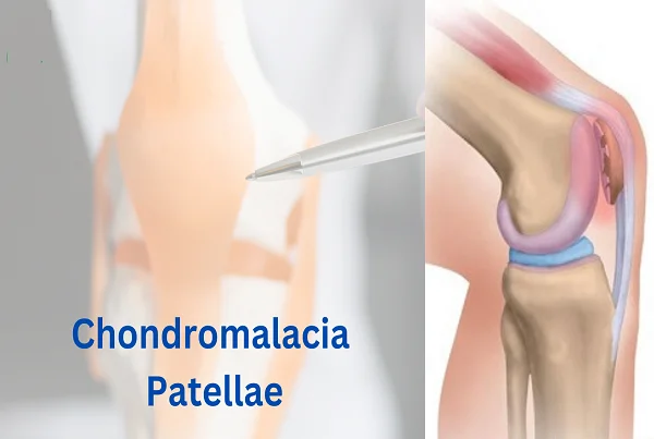 Chondromalacia Patella