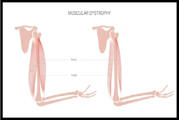 Muscular Dystrophy