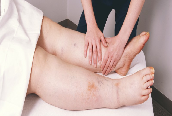 Lymphedema