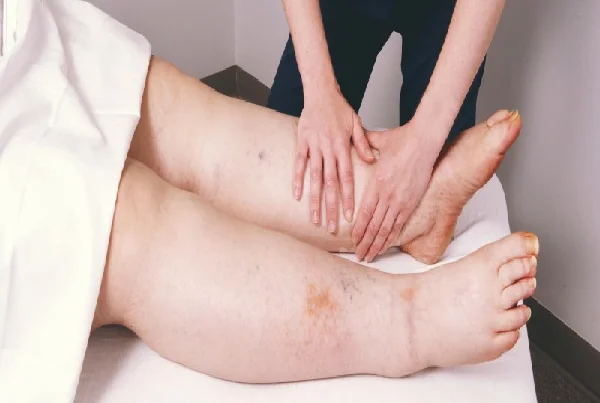 Lymphedema