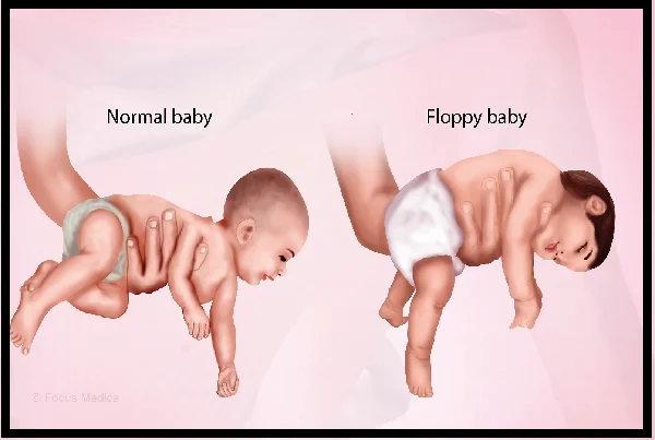 Spastic or Floppy Child
